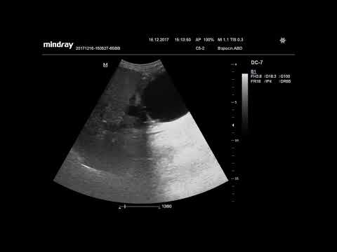 Видео: УЗИ. Доктор Иогансен. Видеопримеры.  Выпуск 5. Кисты поджелудочной железы.