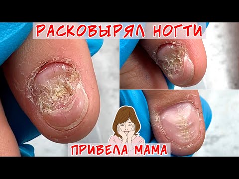 Видео: Расковырял ногти до бугров / Волны и полосы на ногтях