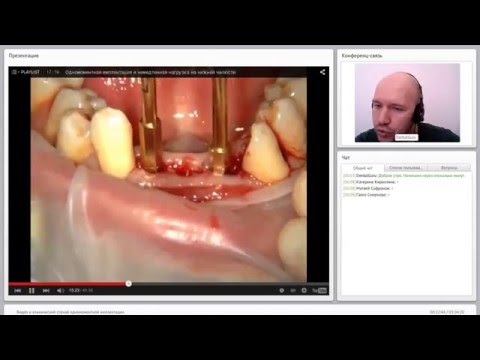Видео: 2015 08 11 Видео и клинический случай одномоментной имплантации