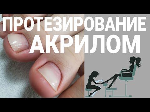 Видео: ПРОТЕЗИРОВАНИЕ АКРИЛОМ / вросший ноготь / восстанавливаем углы и боковые стенки / педикюр подростку