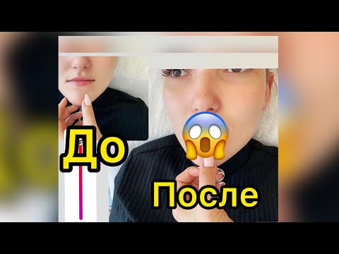 Видео: Сделала губы! Реакция мамы, Димы.