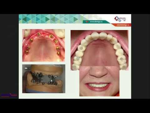 Видео: 2018 02 27  ХАБИЕВ К    Ортопедические и хирургические аспекты тотального протезирования с немедленн