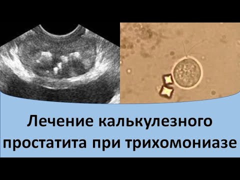 Видео: Лечение калькулезного простатита при трихомониазе
