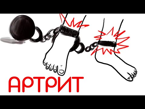 Видео: Ревматоидный артрит: основы эффективного лечения // Доктор Ху