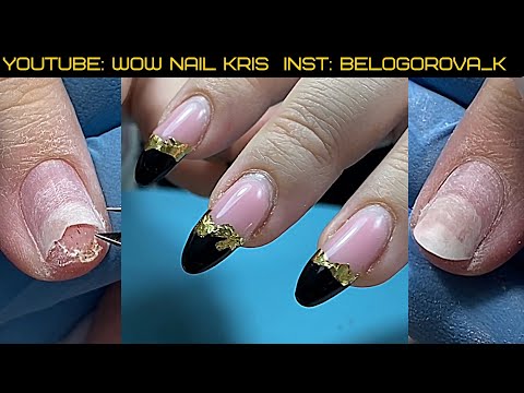 Видео: Вырвала ноготь в мясо в драке🤪| Травма| Онихолизис и зачистка