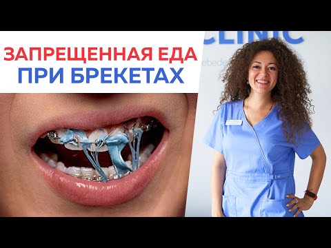 Видео: Что нельзя есть с брекетами? / Правила питания при ношении брекетов
