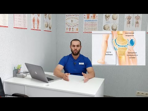 Видео: Киста Бейкера | Как убрать? | Эффективные методы | Baker's cyst exercises