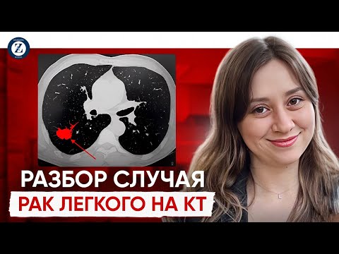 Видео: Разбор КТ рака легкого. Замятина Ксения Андреевна