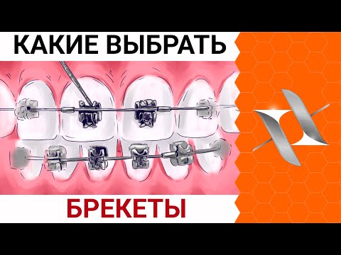 Видео: Какие ВЫБРАТЬ БРЕКЕТЫ в 2022 | Лигатурные vs самолигирующиеся