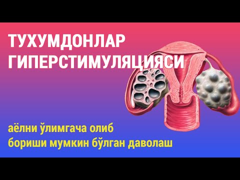 Видео: Тухумдонлар гиперстимуляцияси: аёлларни ўлимга олиб борувчи даволаш