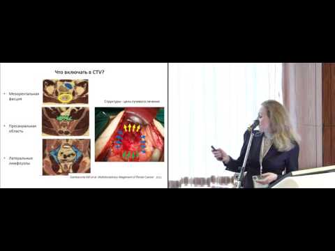 Видео: IMRT, VMAT технологии в комплексном лечении больных аденогенным раком прямой кишки