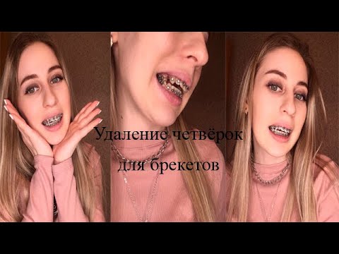 Видео: Удаление четвёрок для брекетов 🤭 мой личный опыт