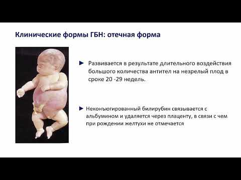 Видео: Лекция № 7 Гемолитическая болезнь новорожденных