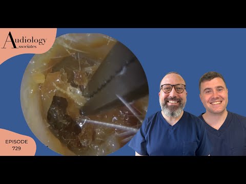 Видео: Удаление огрубевшей кожи из уха - EP729