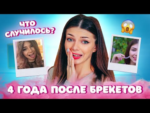 Видео: 4 Года После БРЕКЕТОВ и ЭЛАЙНЕРОВ зубы Разъехались? | Стоит ли ставить Ретейнеры, Капы?