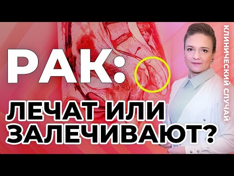 Видео: Рак: лечат или залечивают?