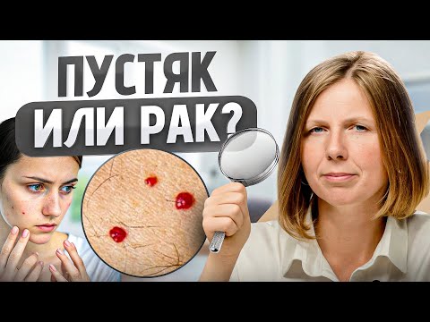 Видео: О чем КРИЧАТ красные родинки на теле? Люди зря недооценивают ЭТИ точки...
