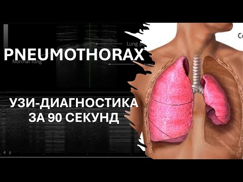 Видео: ПНЕВМОТОРАКС. ПРИКРОВАТНОЕ УЗИ ЗА 90 СЕКУНД #узи #ultrasound #emergency #pneumothorax