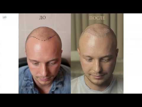 Видео: Пересадка волос методом HFE