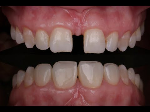 Видео: Закрытие диастемы. Стоматология. Зубы. Стоматолог. Диастема