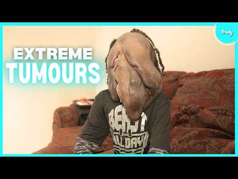 Видео: Невероятные люди, живущие с гигантскими опухолями | РОЖДЕНЫ ДРУГИМИ