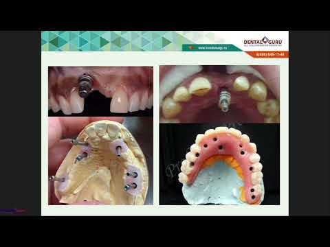 Видео: "Хабиев К.Н. Осложнения при протезировании на имплантатах"(25.06.2019)