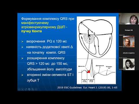 Видео: Синдром передчасного збудження шлуночків