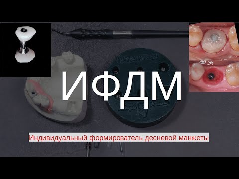 Видео: ИФДМ (индивидуальный формирователь десневой манжеты)