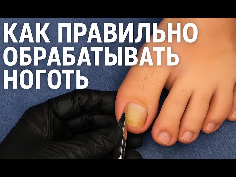 Видео: Удаляю вросший ноготь без боли | Профессиональный педикюр