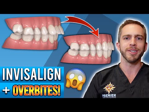 Видео: Лечение прикуса Invisalign! [ДО И ПОСЛЕ]