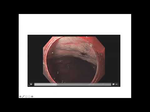 Видео: 2 Мальков В.А. Диагностика аутоиммунного атрофического гастрита