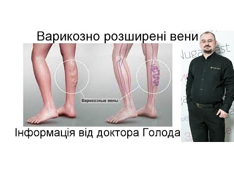 Видео: 25. Варикозне розширення вен