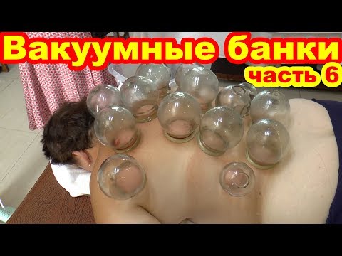 Видео: Китайские вакуумные банки. Лечение иглоукалыванием. Госпиталь ТКМ. Санья. Хайнань. Китай 🏥