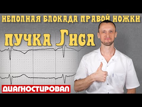 Видео: Блокада правой ножки пучка Гиса