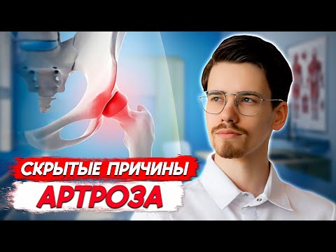 Видео: КОКСАРТРОЗ. Лечение артроза тазобедренного сустава. P-DTR