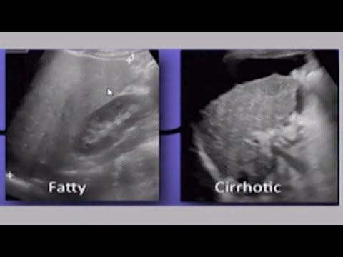 Видео: Чернодробна стеатоза и цироза