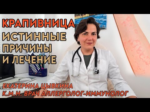 Видео: Крапивница, настоящие причины и лечение. Врач аллерголог иммунолог Екатерина Цывкина.