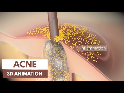 Видео: Основы акне | Патофизиология и лечение | 3D-анимация