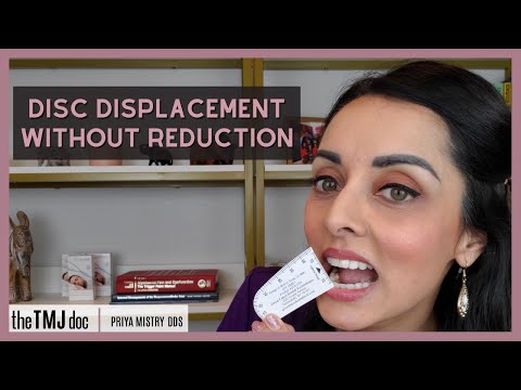 Видео: Смещение диска без вправления - Прия Мистри, DDS (документ ВНЧС) #articulardisc #jawlocked #tmd