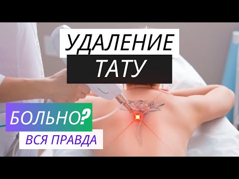 Видео: УДАЛЕНИЕ ТАТУ ЛАЗЕРОМ | Мой опыт и рекомендации