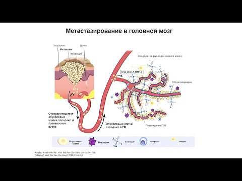 Видео: Метастатическое поражение головного мозга при меланоме. Как выбрать правильный алгоритм лечения?