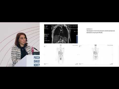 Видео: Исходно резектабельный рак поджелудочной железы. Выбор системной терапии 1-2 линии