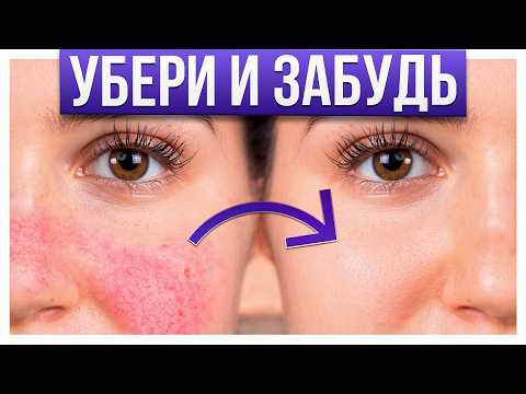 Видео: ЭТО поможет ПОБОРОТЬ розацеа! / Как избавиться от РОЗАЦЕА за месяц: Реальные методы лечения