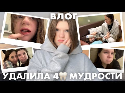 Видео: УДАЛИЛА 4 зуба МУДРОСТИ за раз | мой опыт | влог 🦷