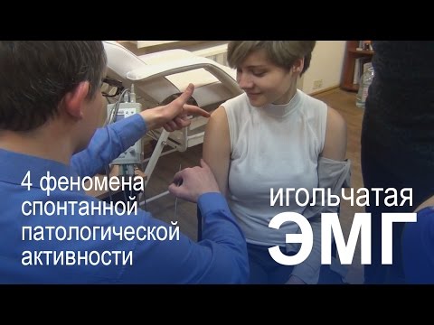Видео: Игольчатая электромиография (ЭМГ). Феномены спонтанной патологической активности