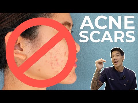 Видео: Как избавиться от шрамов от угревой сыпи | Доктор Дэвин Лим
