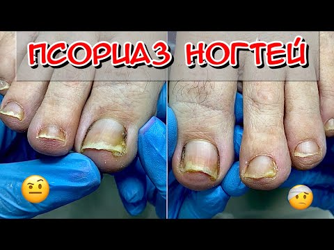 Видео: Псориаз ногтей / Псориаз на ногах / Псориаз что это? / Подология / Педикюр