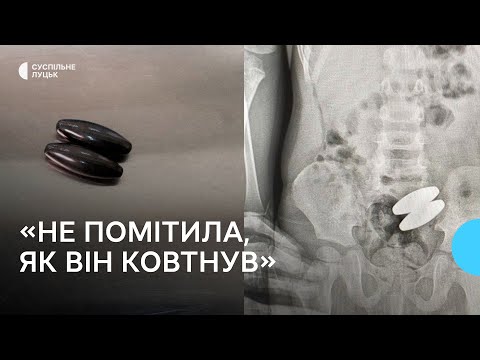 Видео: У Луцьку рятують дворічного хлопчика, який проковтнув два магніти