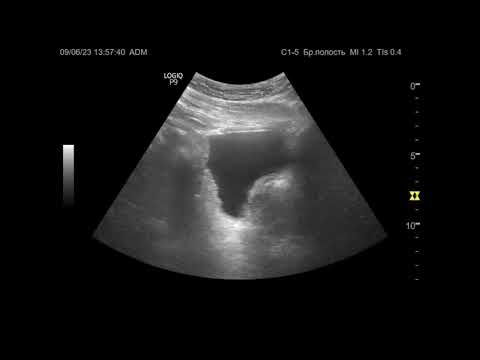 Видео: УЗИ. Доктор Иогансен. Видеопримеры. Выпуск 19. Гиперплазия предстательной железы.