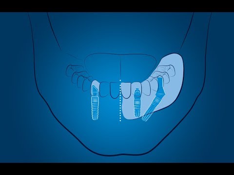Видео: Лечение със зъбни импланти в ЕО Дент